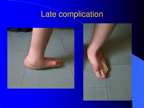 Ppt Congenital Clubfoot Congenital Talipes Equino Varus Powerpoint Presentation Id9549173