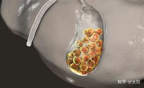 肝内胆管结石严重吗？胆囊癌与肝内胆管结石有关系 知乎