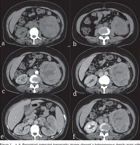 Figure 1 From Malignant Renal Epithelioid Angiomyolipoma With Tfe3 Gene