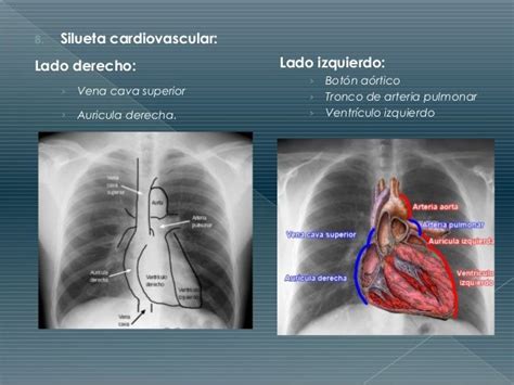 Resultado De Imagen Para Boton Aortico Boton Pulmonar Radiología