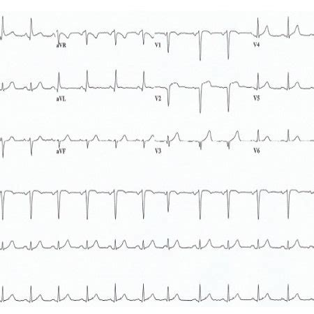 Electrocardiogram Demonstrating Sinus Rhythm With Mm St Elevations In