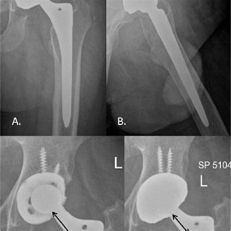 Hip Xrays Postoperative Ap A And Lateral B View Showing Retained