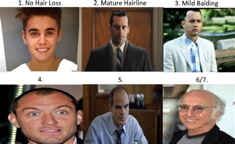 Norwood Scale - Assess Your Hair Loss With Pics & Celebrity Examples