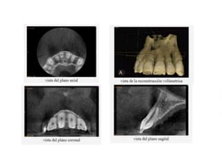 Tomografia De Haz Conico Cone Beam En Odontologia Ppt