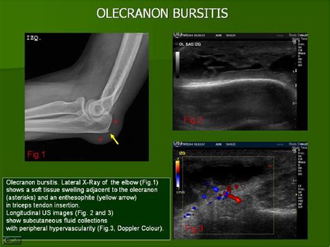 Figure 24 From Ultrasound Of The Elbow What The Radiologist Should