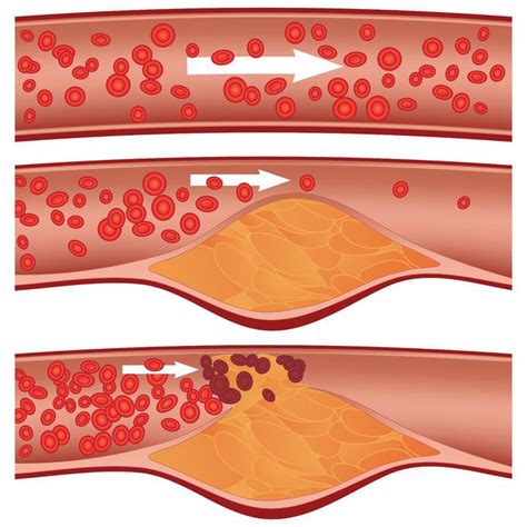 Coronary Artery Disease Atherosclerosis - Cardiology - Highland ...