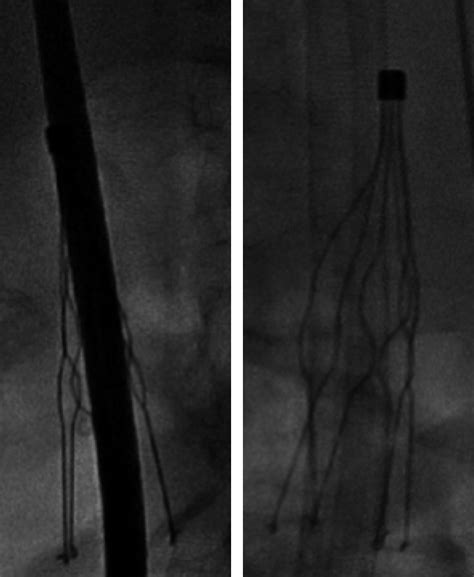 Successful Implantation Of A Micra Leadless Pacemaker Via Collateral