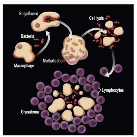 Chronic Granulomatous Lymphadenitis Basicmedical Key