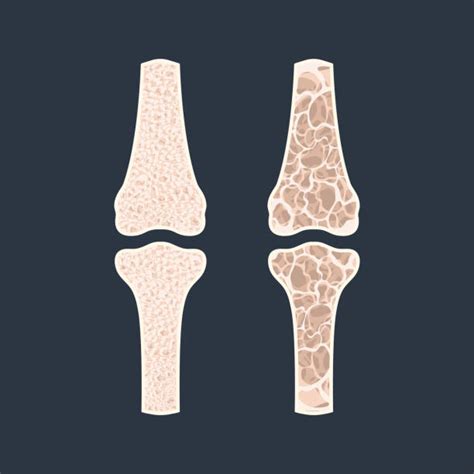 Osteoporosis Fracture Illustrations Royalty Free Vector Graphics