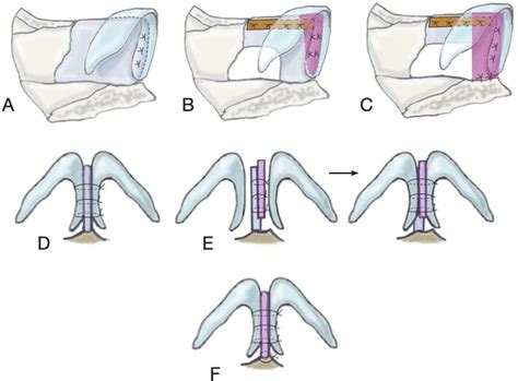 A Tongue In Groove Technique Is Demonstrated In Lateral View With