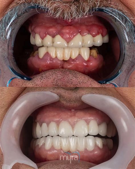 How Much Are Dental Implants In Turkey