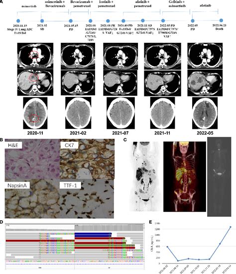 Figure 2 From NSCLC Patients With Rare EGFR Ex19del G724S Mutation