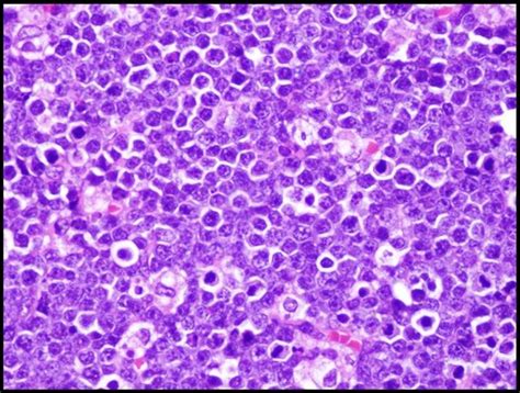 Pathology Outlines Lymphoma