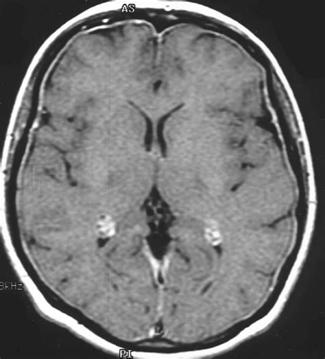 Mri Protocols Meningitis Mri Protocol