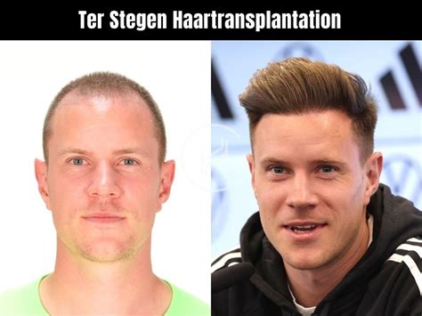 Ter Stegen Haartransplantation Haarausfall Und Technische Analyse