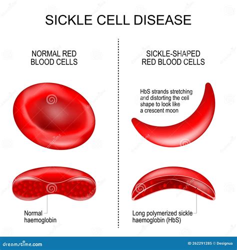 Anemia Falciforme Illustrazione Vettoriale Illustrazione Di