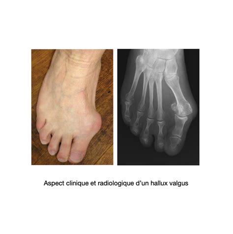 Hallux Valgus S V Re Dr Bovier Lapierre