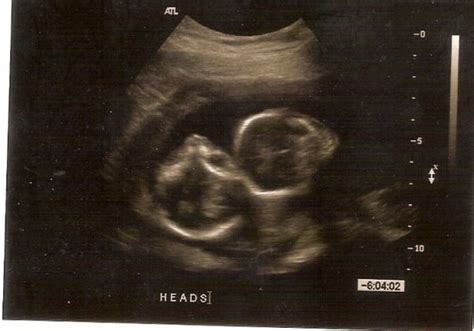 13 Weeks Pregnant Ultrasound Twins