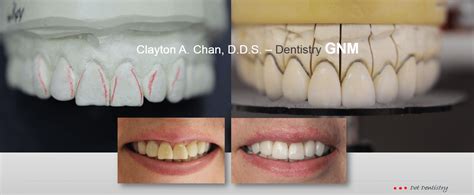 Occlusal Waxing To The Gnm Position Occlusion Connections