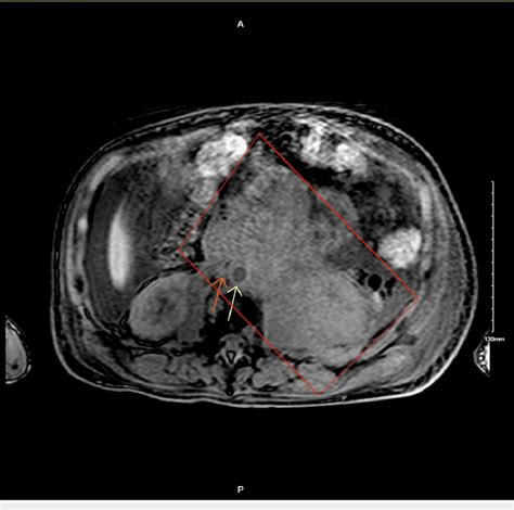 MRI of the abdomen without contrast showing a large infiltrative left... | Download Scientific ...