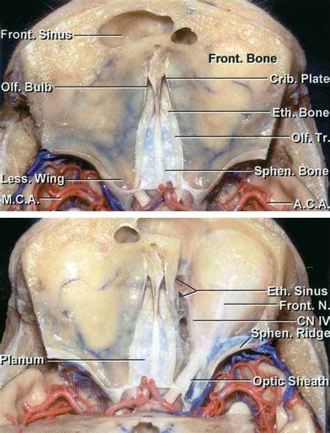 Bifrontal Craniotomy The Neurosurgical Atlas