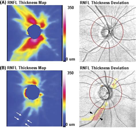 Retinal Nerve Fiber Layer Imaging With Spectral Domain Optical Coherence Tomography Ophthalmology