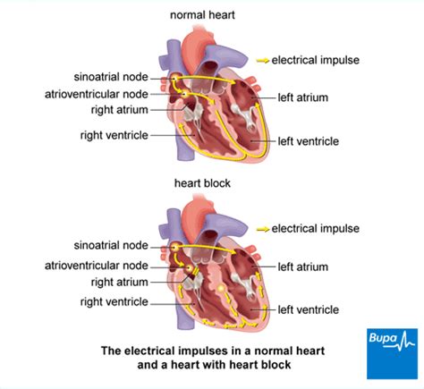 Different Types Of Heart Blocks