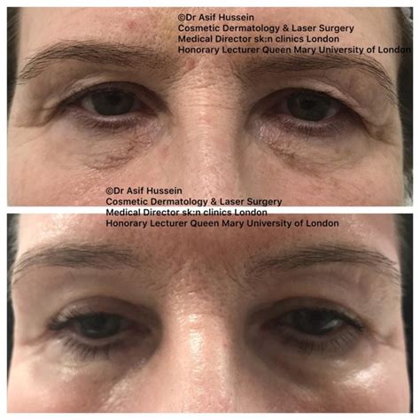 Laser Eyelid Tightening Surgery Treatment Dr H Consult