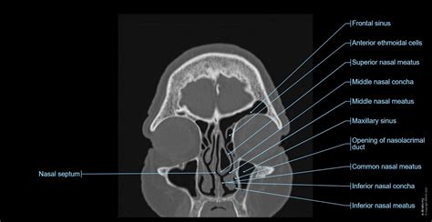 Cranial Bone Anatomy Ct Axial
