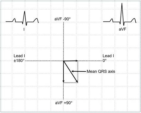 Electrical Axis In Ecg All About Cardiovascular System And Disorders