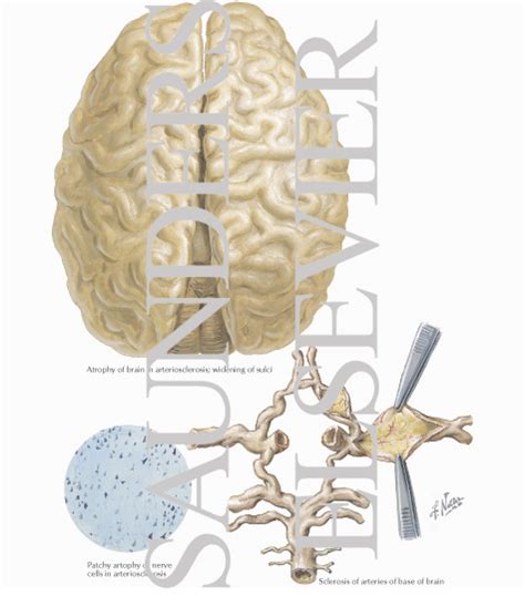 Cerebral Arteriosclerosis