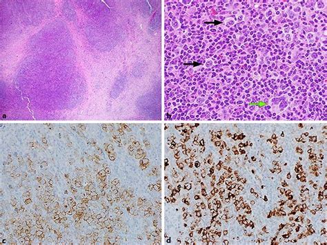 Pathology Of The Right Axillary Lymph Node A He Stains Of The Specimen