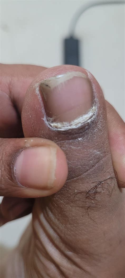 Please Help If These Are Psoriasis Psoriatic Nails Rpsoriasis