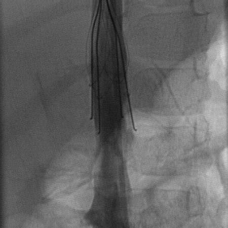 Image from a 2-year-old boy with an IVC aneurysm. Venogram after ...