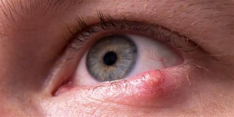 Chalazion: Causes, Symptoms, Risk Factors And Treatment | OnlyMyHealth