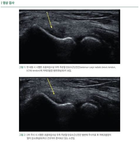 주관절 외상과염에서 항염 효과로 통증 개선을 유도하는 지씨웰빙디옥시®주의 효능