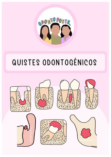 Quistes Odontog Nicos Odonto Posts Udocz