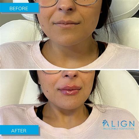 Before After Results Align Injectable Aesthetics