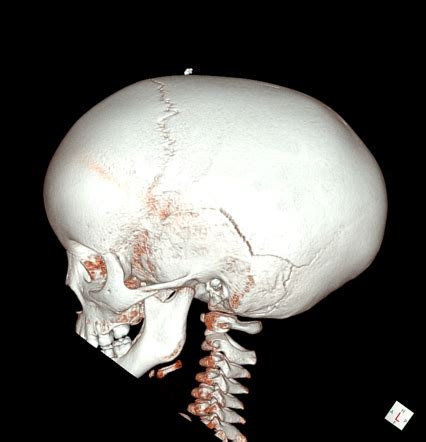 Scaphocephaly Image Radiopaedia Org