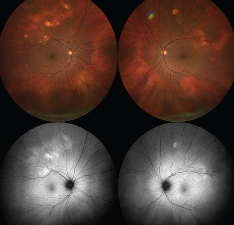 March Wills Eye Resident Case Series