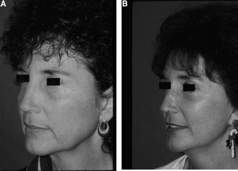 Facelift Operative Techniques In Otolaryngology Head And Neck Surgery