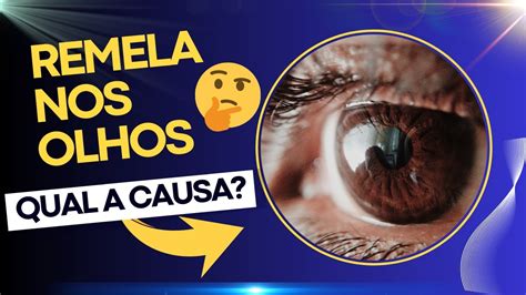 O Que Causa Remela Nos Olhos - Dicas de Saúde Dr Marcelo Sandrín: O que causa excesso de Remela nos ...
