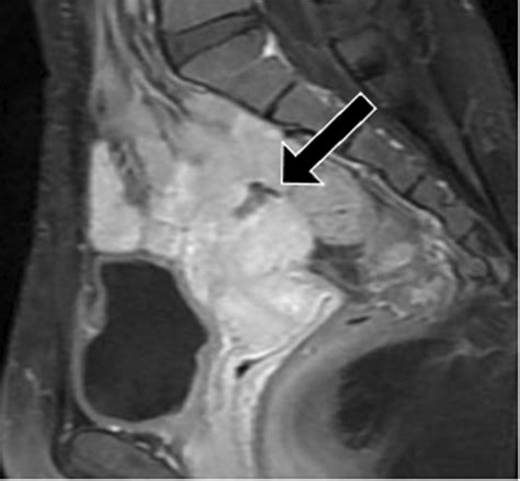 Sagittal T1‐weighted Magnetic Resonance Imaging With Contrast At