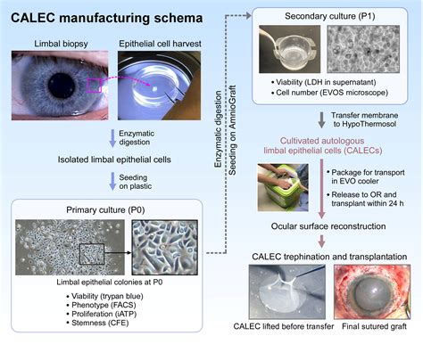 Cultivated Autologous Limbal Epithelial Cell Calec Transplantation