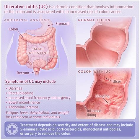 Qué es la colitis ulcerosa Síntomas diagnóstico tratamiento y