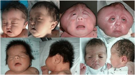 Congenital Deformity – Types, Causes, and Treatments - Sound Health Doctor