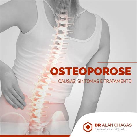 Osteoporose Causas Sintomas E Tratamento Dr Alan Chagas