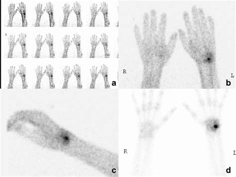 Three Phase Bone Scan Of The Wrists And Hands Performed In 2010 The