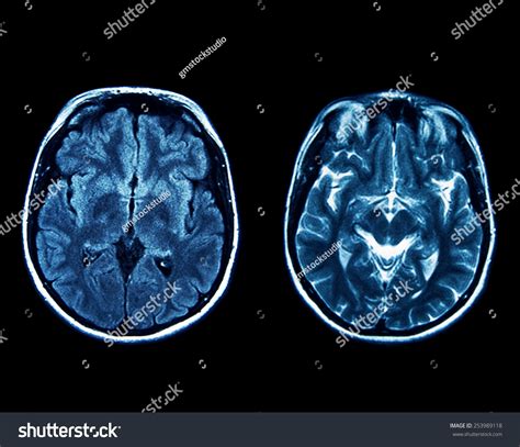 Mri Scan Brain Stock Photo 253989118 | Shutterstock