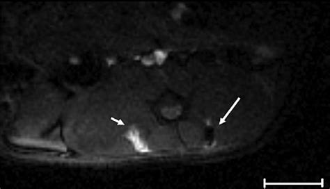 MR imaging Gradient echo GRE image TR 8 ms TE ms α 30 of both